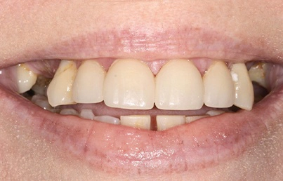 Smile gallary image - Before